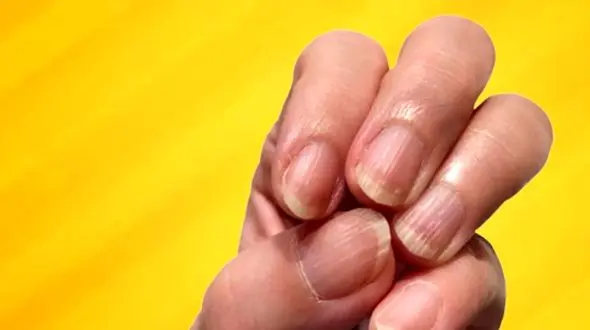 دلایل ایجاد خطوط عمودی یا افقی روی ناخن چیست؟