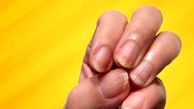 دلایل ایجاد خطوط عمودی یا افقی روی ناخن چیست؟