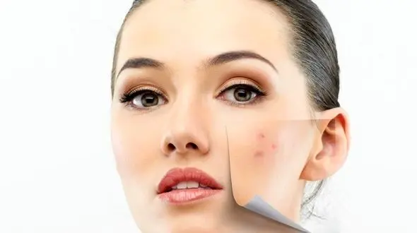 ماسک های خانگی رفع جوش های بدن