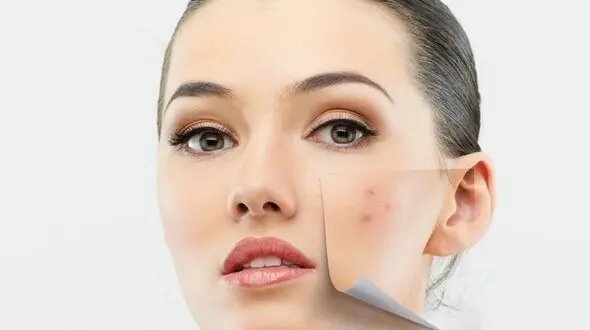 ماسک های خانگی رفع جوش های بدن