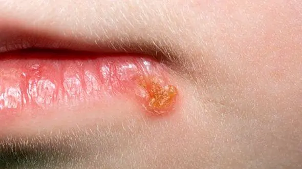 روش های درمانی یک بیماری ویروسی