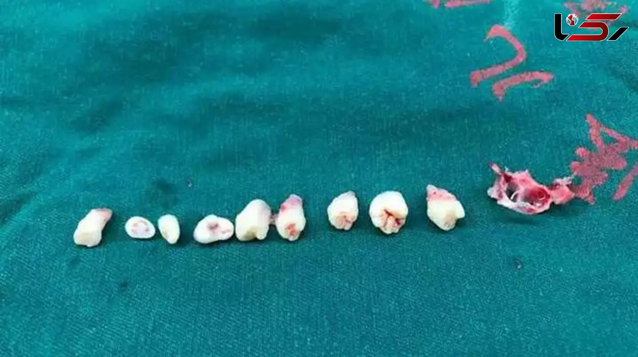 دهان این کودک در مغزش بود! + عکس 