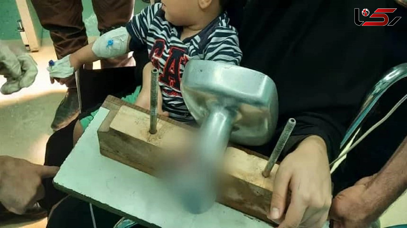 چرخ گوشت انگشت دست پسر 2 ساله را چرخ کرد / در بروجن رخ داد + عکس