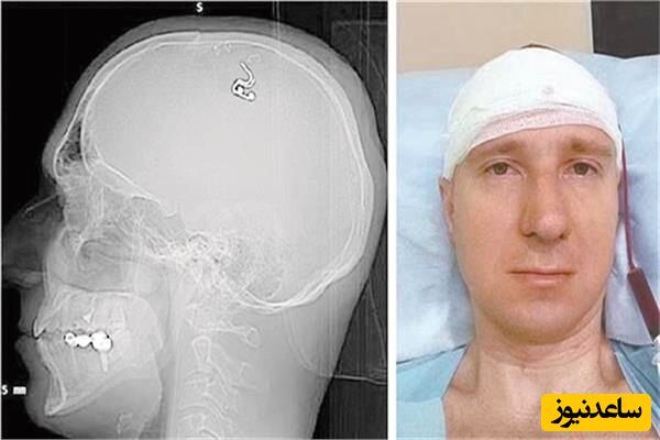 این مرد روس با دریل به جان جمجمه خود افتاد و مغز خود را سوراخ کرد +عکس