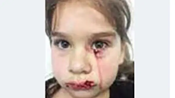 حمله سگ وحشی به دختر امریکایی