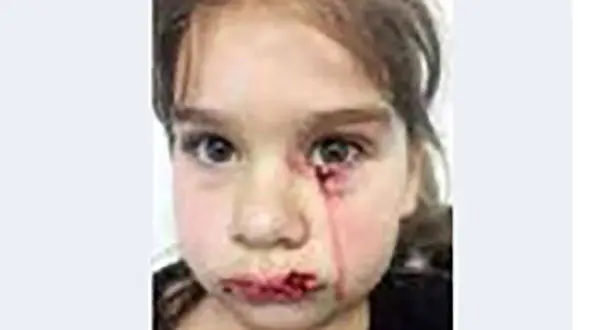 حمله سگ وحشی به دختر امریکایی