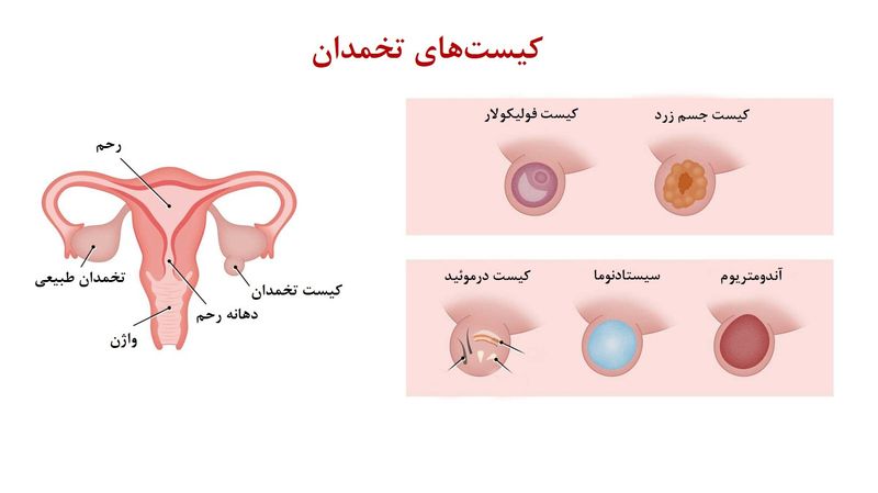 کیست تخمدان چیست؟ / انواع جراحی کیست تخمدان + جدول جامع