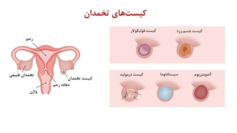 کیست تخمدان