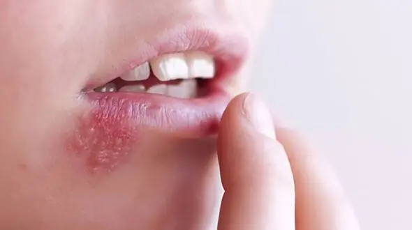 راز عود تبخال در روزهای پرتنش؛ چرا استرس ویروس خفته را بیدار می‌ کند؟