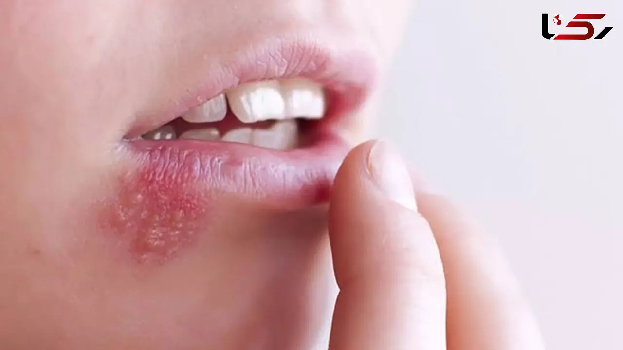 راز عود تبخال در روزهای پرتنش؛ چرا استرس ویروس خفته را بیدار می‌ کند؟