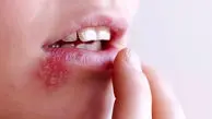 راز عود تبخال در روزهای پرتنش؛ چرا استرس ویروس خفته را بیدار می‌ کند؟