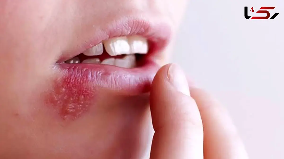 راز عود تبخال در روزهای پرتنش؛ چرا استرس ویروس خفته را بیدار می‌ کند؟