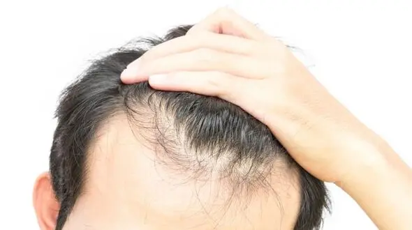 چرا برخی افراد زود موهای شان چرب می شود؟