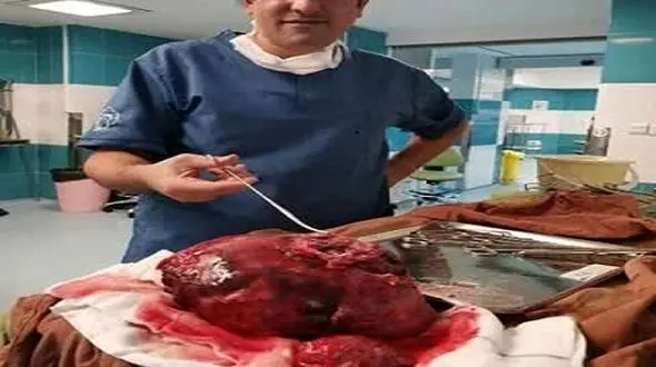 راز شکم برآمده جوان 24 ساله چه بود ! / پزشکان یزدی شوکه شدند !