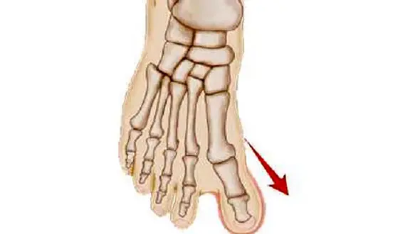 انحراف انگشت شست پا + نشانه ها