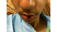 ضرب و شتم شدید دانش‌آموز جیرفتی توسط مدیر مدرسه + عکس