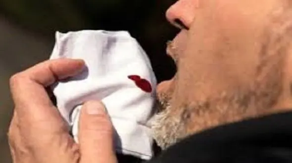 آخرین وضعیت «سل» در ایران/ تشخیص و درمان رایگان بیماری در کشور