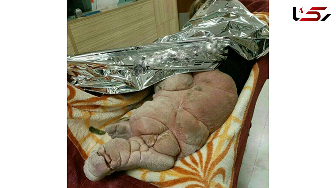 تصویری وحشتناک از یک بیمار تهرانی / او کرم خاکی نیست!+ عکس