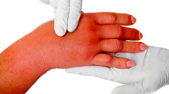 علت و درمان پف بدن بانوان 