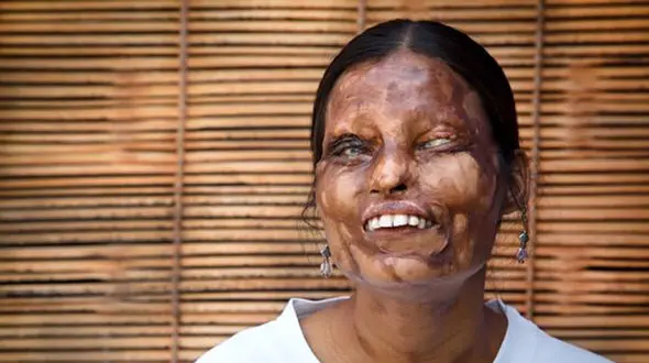 حمله هولناک به چهره زیبای این دختران در نوجوانی+ عکس (14+)