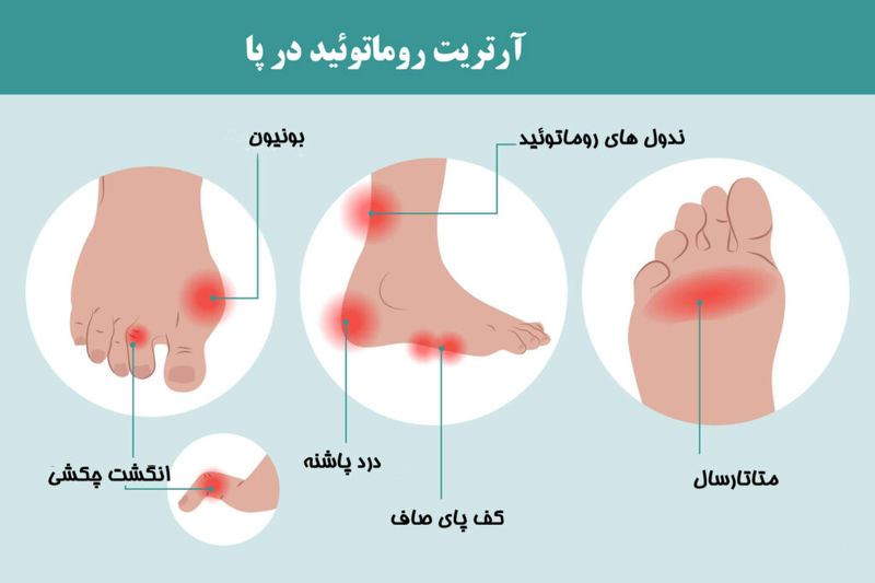 آرتریت در پا