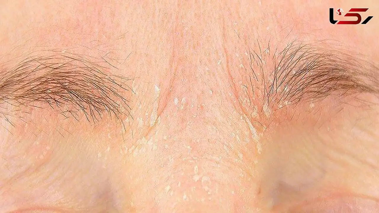 علل و توصیه هایی برای از بین بردن شوره ابرو / پاسخ به سوالات کاربران + اینفوگرافی