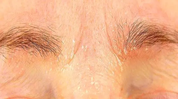 علل و توصیه هایی برای از بین بردن شوره ابرو / پاسخ به سوالات کاربران + اینفوگرافی