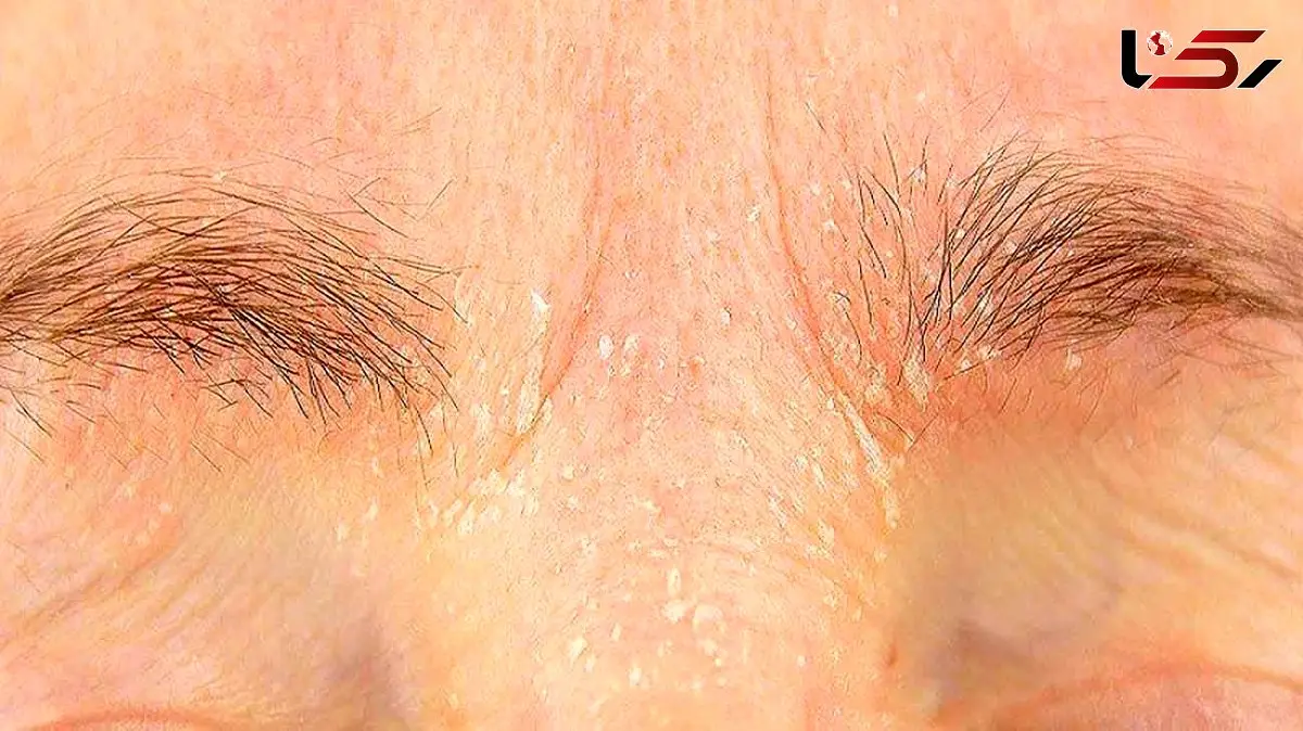 علل و توصیه هایی برای از بین بردن شوره ابرو / پاسخ به سوالات کاربران + اینفوگرافی