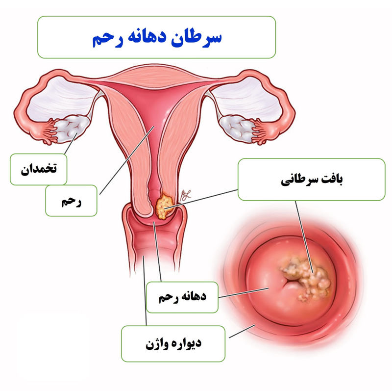 جزئیات سرطان رحم