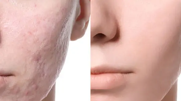 مزوتراپی صورت چیست؟