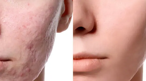 مزوتراپی صورت چیست؟