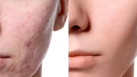 مزوتراپی صورت چیست؟