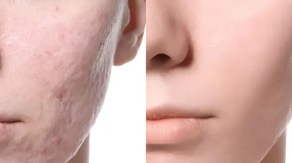 مزوتراپی صورت چیست؟