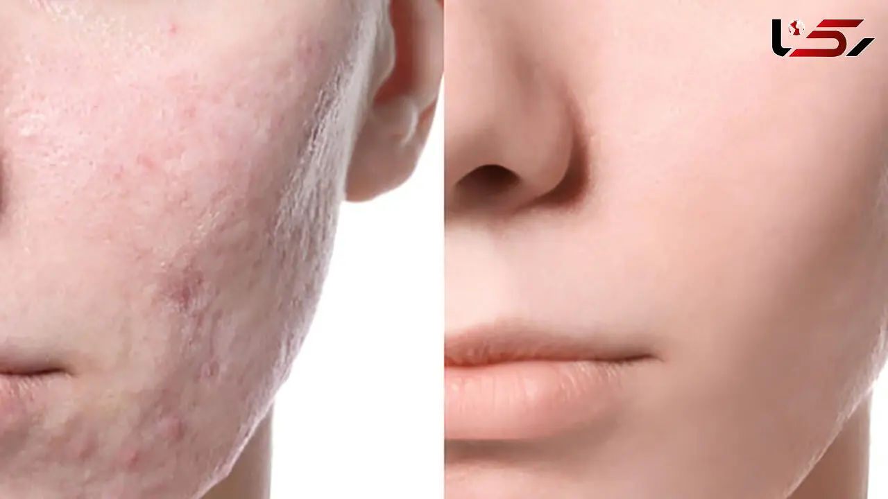 مزوتراپی صورت چیست؟