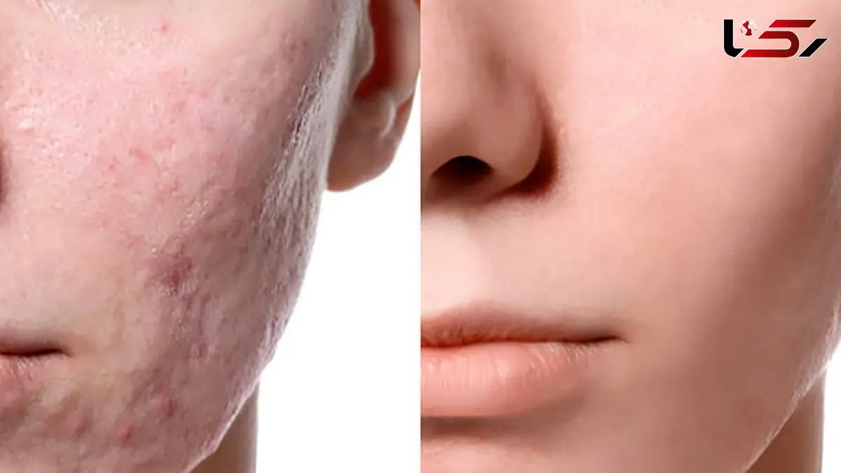 مزوتراپی صورت چیست؟