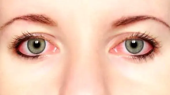 لکه های قرمز چشم نشانه چه بیماری هایی است؟