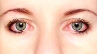 لکه های قرمز چشم نشانه چه بیماری هایی است؟