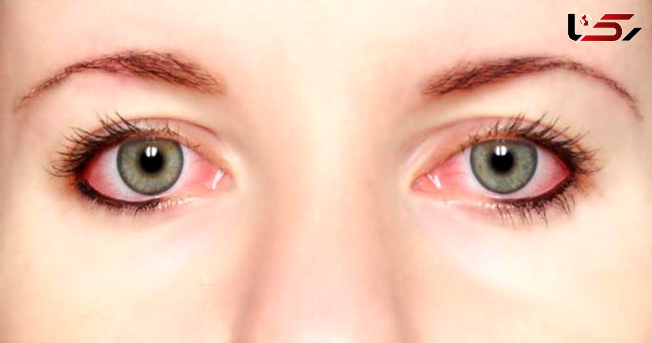 لکه های قرمز چشم نشانه چه بیماری هایی است؟