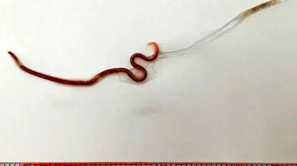 خارج کردن کرم زنده از گلوی یک زن جوان  + عکس