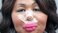 Bank robber who stole to pay for gender reassignment surgery given away by bandaged nose
