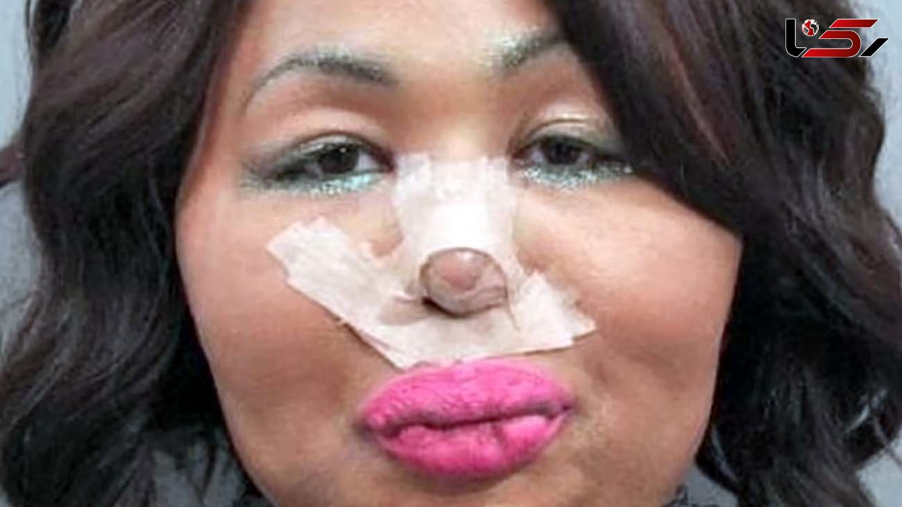 Bank robber who stole to pay for gender reassignment surgery given away by bandaged nose
