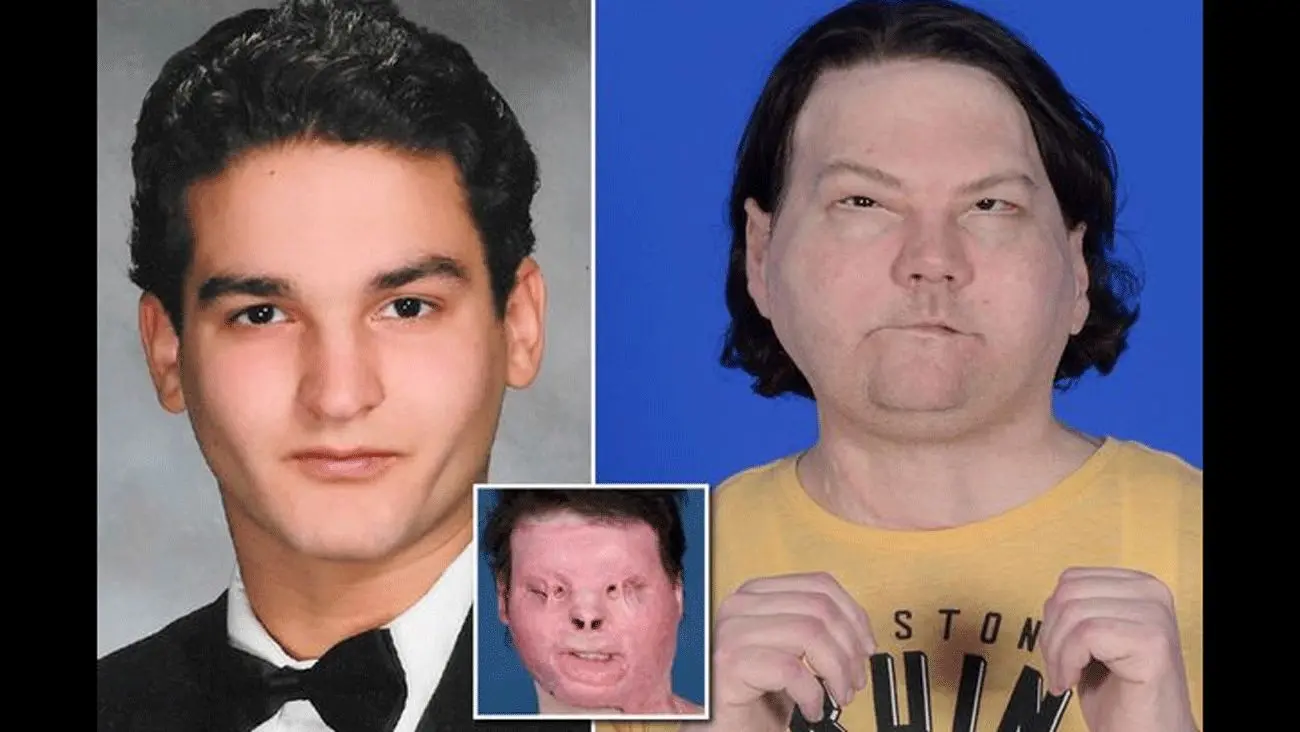 Man Has World S First Successful Face And Double Hand Transplant After Horror Crash