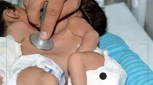 تلاش متخصصان شیرازی برای جداکردن دوقلوهای به‌هم‌چسبیده اهوازی