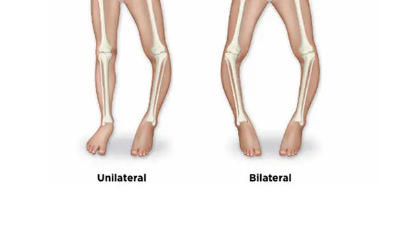 4 علت بروز پای پرانتزی در افراد + ورزش های اصلاحی