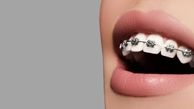 ارتودنسی، چه نقشی در درمان مشکلات دندانی دارد؟ /  بهترین سن برای ارتودنسی چه زمانی است؟