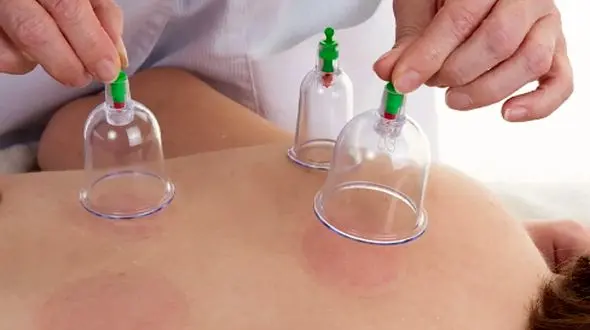 حجامت در تابستان: راهی مؤثر برای بهبود حال عمومی و طراوت بدن