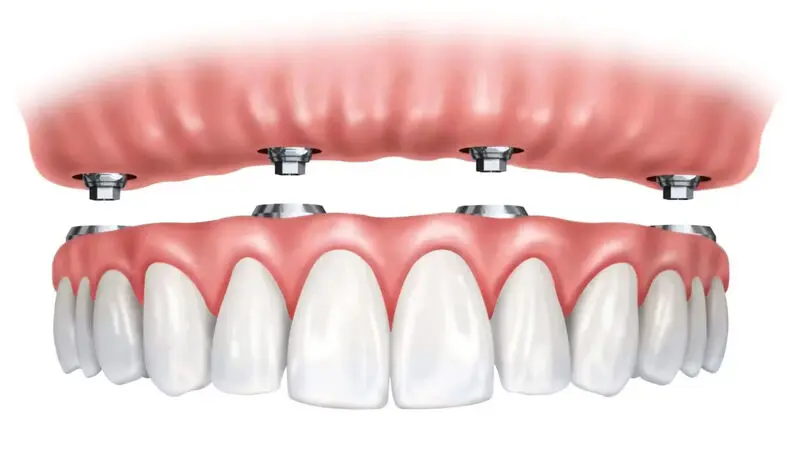 ایمپلنت دندان