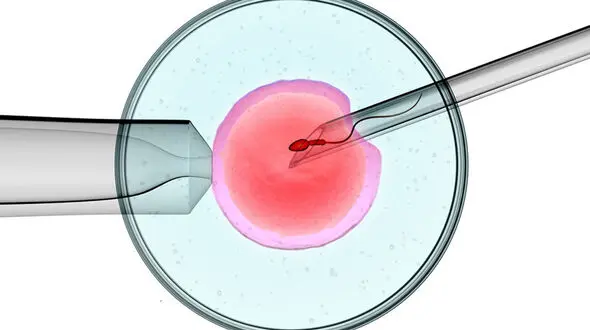 iui چیست؟ + جزئیات شانس بارداری 