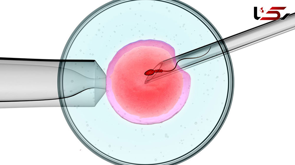 iui چیست؟ + جزئیات شانس بارداری 