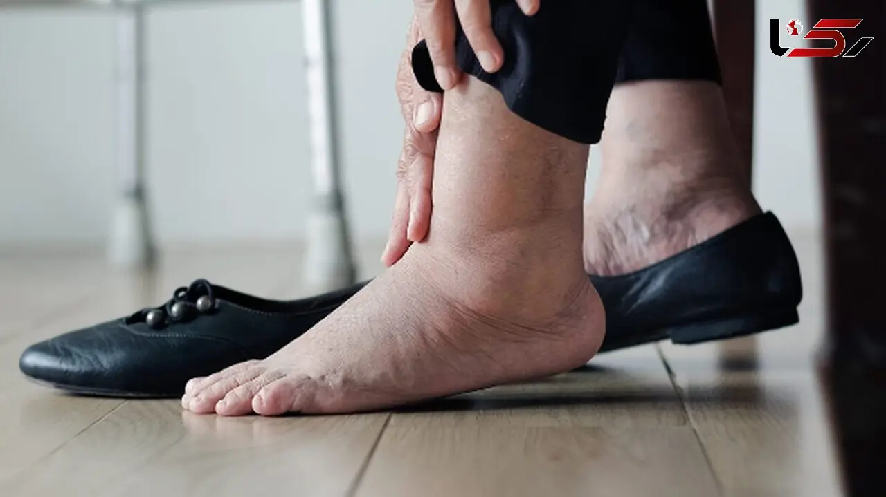 آیا تورم پا به خستگی محدود می‌شود یا زنگ خطری برای قلب است؟